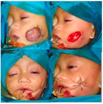 The Role Of Purse String Closure As The Primary Treatment Of Hemangioma