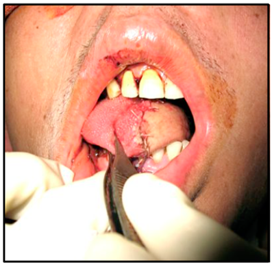 Treatment of Buccal Lymph-hemangioma
